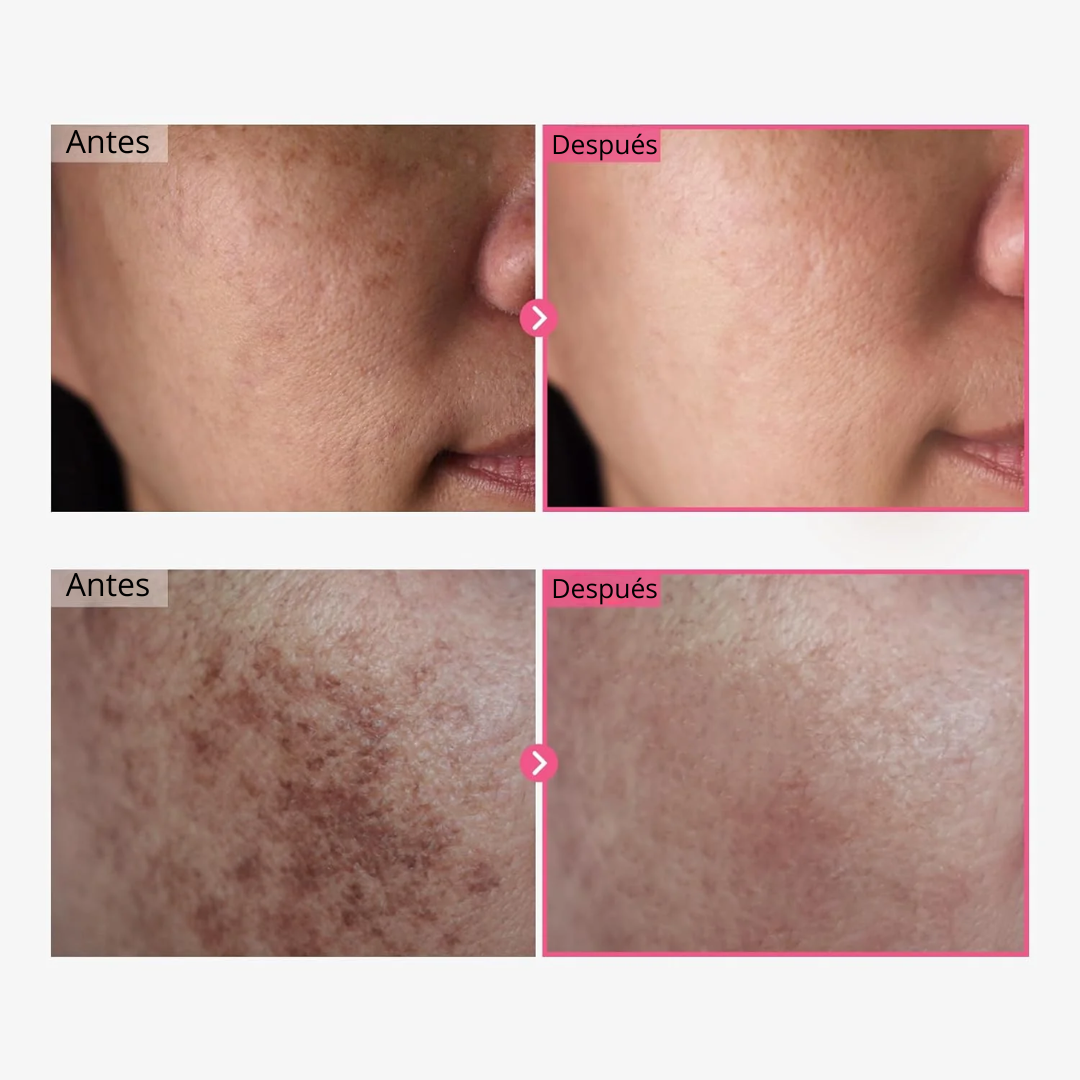 Luméa Crema: Arbutina 7% + Ácido Tranexámico 4% - 50gr