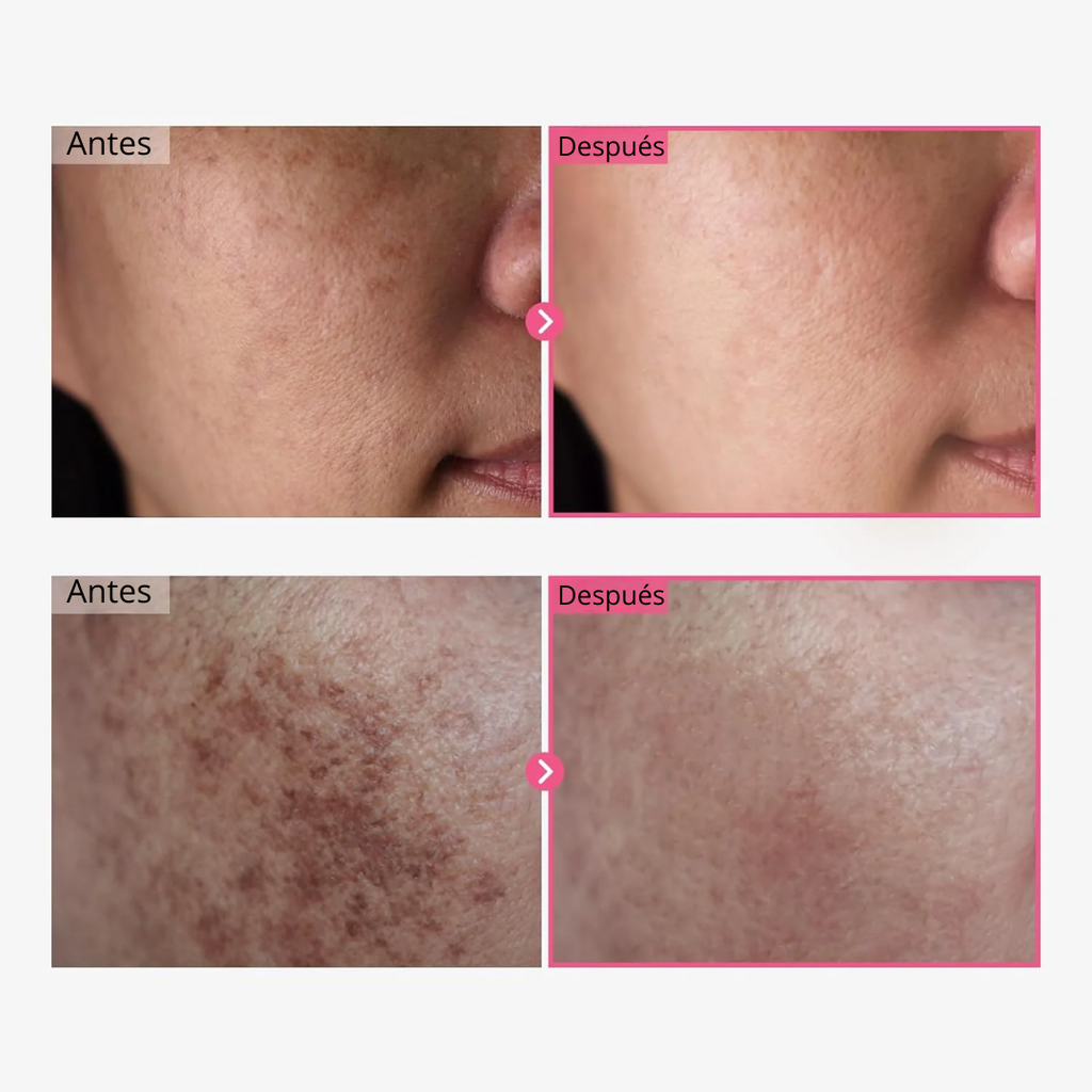 Luméa Crema: Arbutina 7% + Ácido Tranexámico 4% - 50gr
